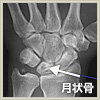 キーンベック病の月状骨の写真