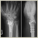 橈骨末端骨折02の写真