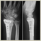 橈骨末端骨折03の写真