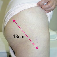 従来法を用いた皮膚切開の痕（術後8年）の写真