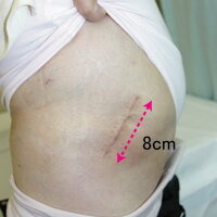 最小侵襲手術を用いた皮膚切開の痕（術後2ヶ月）の写真