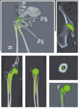 当院で使用する３次元テンプレートシステム（ZedHip）の写真