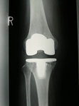 全置換型人工膝関節のレントゲン写真