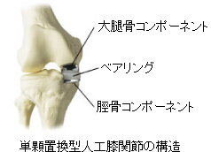 単顆置換型人工膝関節の構造のイラスト
