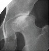 骨頭壊死症の股関節のレントゲン写真