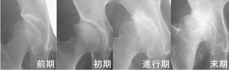 関節の隙間