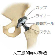 人工股関節の構造