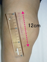 （術後3ヶ月・皮切12cm）