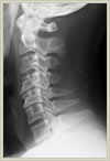 頚椎症性脊髄症、頚椎椎間板ヘルニア02