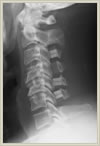 頚椎症性脊髄症、頚椎椎間板ヘルニア03
